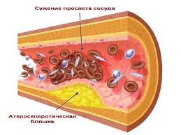 Атеросклероз