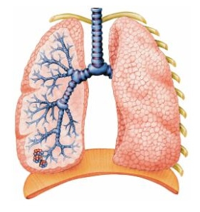 bronchitis-chronic Хронический бронхит