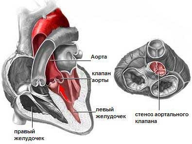 _стеноз Аортальный стеноз