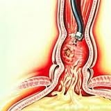 _расширение_вен_пищевода_с_кровотечением2 Варикозное расширение вен пищевода с кровотечением