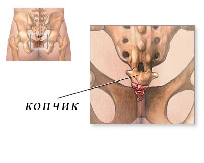 2 Анокопчиковый болевой синдром