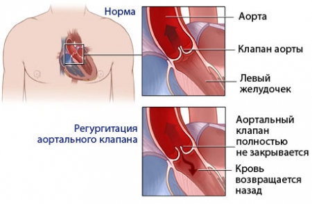 _недостаточность.2_ Недостаточность аортального клапана