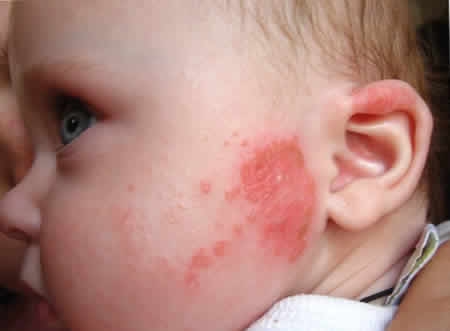 atopicheskij_dermatit_u_detei Атопический дерматит
