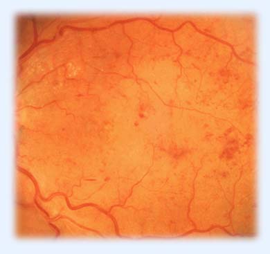 neproliferativnaya.diabeticheskaya_.retinopatia_.2_ Ретинопатия диабетическая