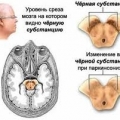 Болезнь Паркинсона