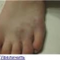 Болезнь Келлера