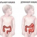 Болезнь Гиршпрунга