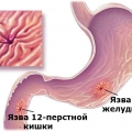 Язвы, желудочно-кишечного тракта