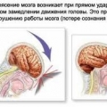 Внутричерепная травма