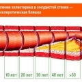 Атеросклероз
