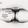 Энтезопатия неуточненная