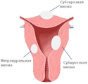 Миома матки