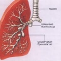 Бронхоэктазы у детей