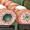 Хроническая пневмония