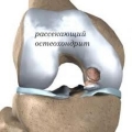 Болезнь Кёнига