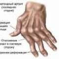 Аутоиммунные заболевания