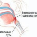 Эпиглоттит (тяжелая инфекция горла)
