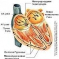 Блокада правой ножки пучка Гиса
