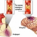 Инсульт ишемический