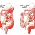 Болезнь Крона (воспаление кишечника)