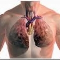 Саркома Капоши у ВИЧ-инфицированных больных