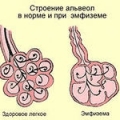 Эмфизема лёгких