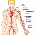 Аортоартериит
