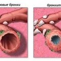 Бронхит