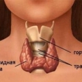 Базедова болезнь