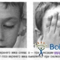 Апоневротической птоз (опущение верхнего века)