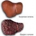 Болезнь Вильсона-Коновалова