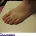 Болезнь Келлера