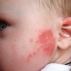 atopicheskij_dermatit_u_detei Атопический дерматит