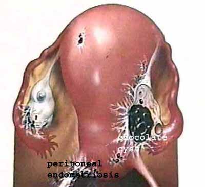 18_endometriosis