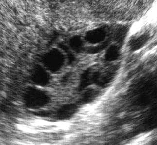 Polycystic_Ovary_Syndrome-1