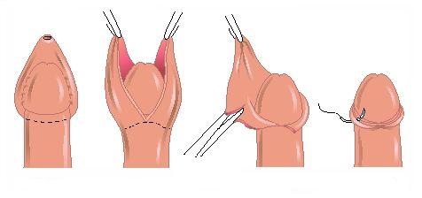 circumcision