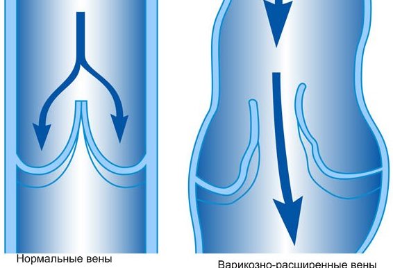 varicose_vein