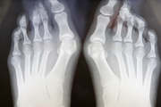 Xray фото