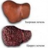 Новый подход в лечении гепатита С