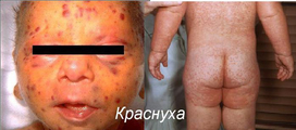 Полио Сэбин Веро sanofi pasteur